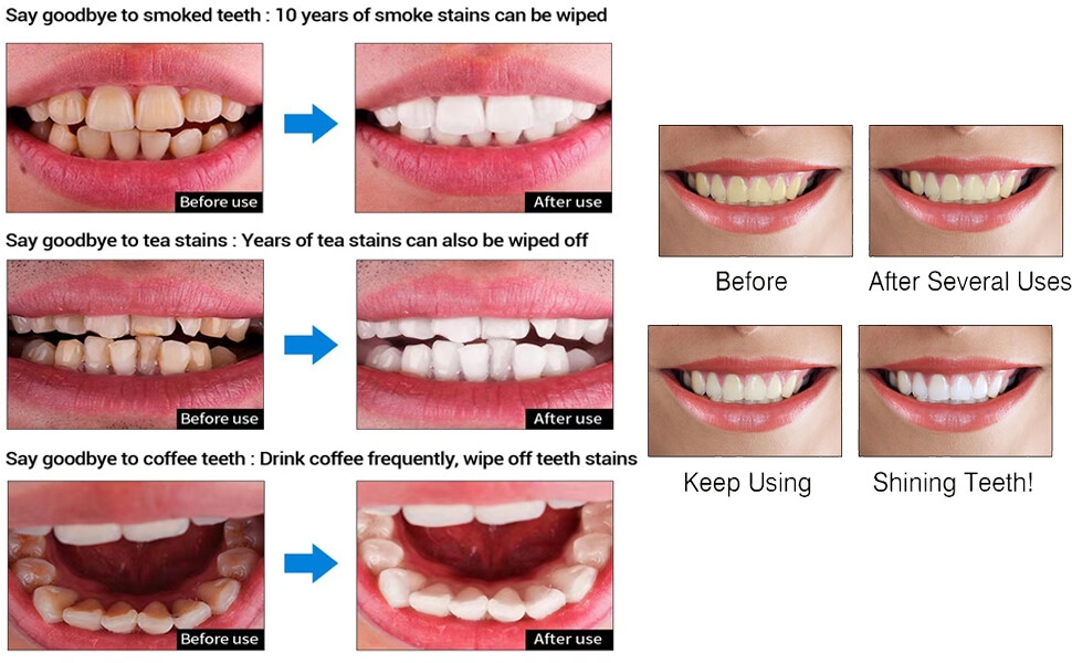 Teeth Whitening Kits