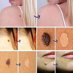 product_image_name-Generic-Skin Tag and Keloid Removing Cream – Red-5