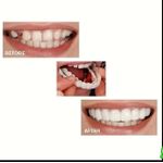 Generic Cosmetic Snap-On Dentures – Temporary Aesthetic Smile Enhancement Teeth Cover (White) - image 2