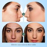 SADOER Tea Tree Acnes Oil Control Face Serum (30ml) – Clear & Radiant Skin Formula - image 6