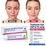 Generic Tretinoin Gel USP 0.1% w/w (A-Ret Gel) – 20g - image 3