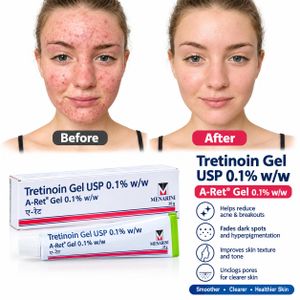 Tretinoin Gel USP 0.1% w/w (A-Ret Gel) – 20g
