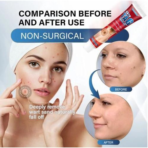 product_image_name-Generic-Skin Tag and Keloid Removing Cream – Red-4